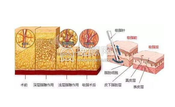 吸脂减肥应注意哪些？