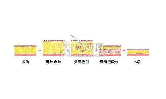 吸脂减肥应注意哪些？