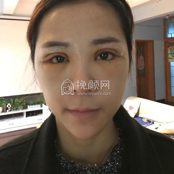 成都美未央医疗美容医院切开双眼皮怎么样？