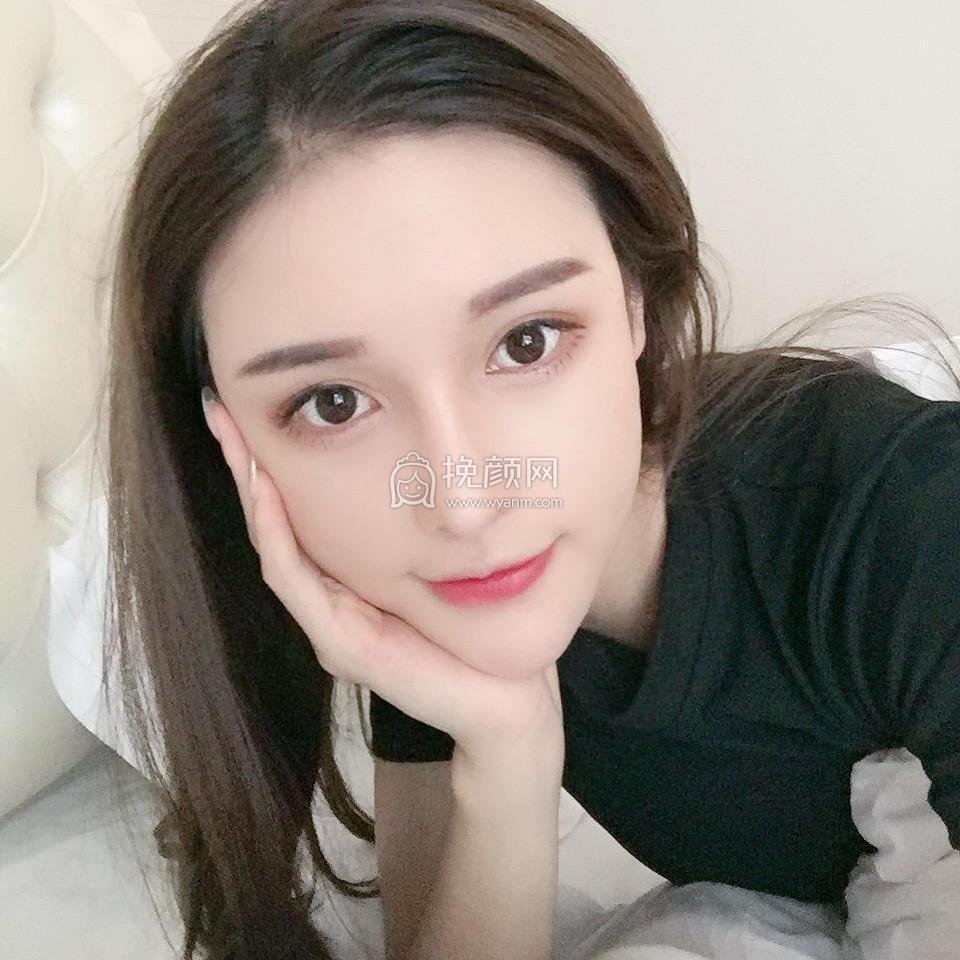 重庆美莱郑楠做的面部吸脂*果怎么样？