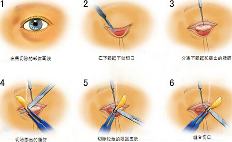 广州曙光整形做祛除眼袋手术价格要多少钱？