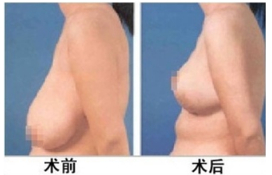 乳房下垂上提术有风险吗？