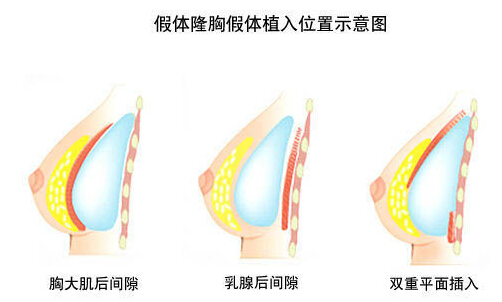 假体隆胸价格多少