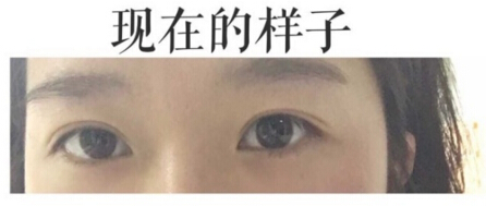 上海九院金蓉医生做的双眼皮手术*果