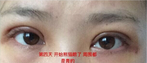 上海九院朱海男医生做的全切双眼皮