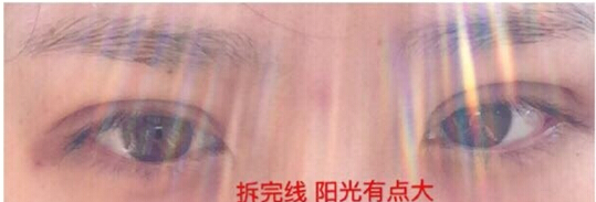 上海九院朱海男医生做的全切双眼皮