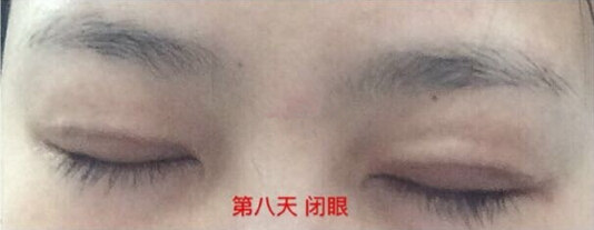 上海九院朱海男医生做的全切双眼皮