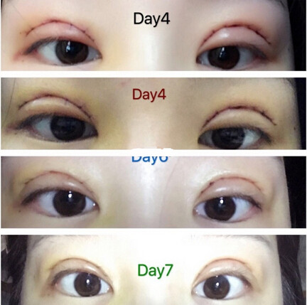 北京八大处刘春军医生处做的全切双眼皮