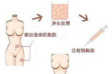 假体隆胸能保持多久?