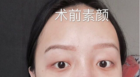 重庆艺星整形医院段医生做的全切双眼皮和开内