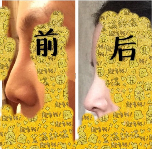 南宁美丽焦点焦俊光做的注射物取出、*