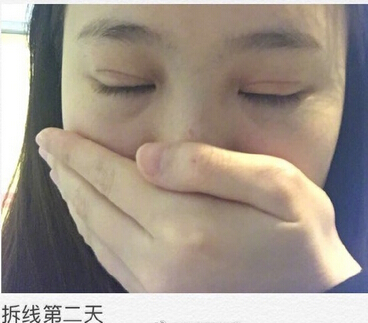 深圳美莱医院陈磊医生价格3000做的双眼皮