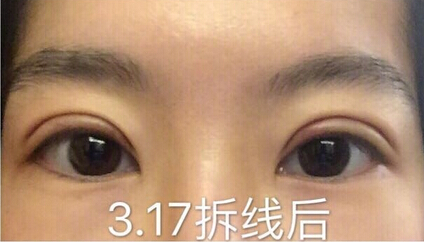 陆新医生做的全切双眼皮，价格不到3850