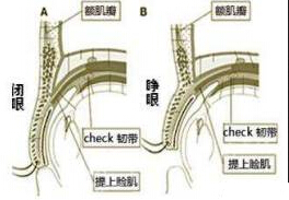 我的眼睛是不是睑下垂？到底要不要做提肌？