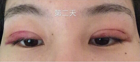 武汉天佑医院整形美容科做双眼皮怎么样？