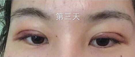 武汉天佑医院整形美容科做双眼皮怎么样？