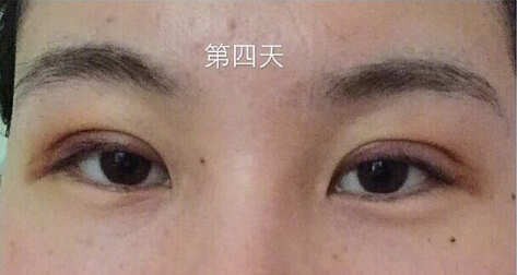 武汉天佑医院整形美容科做双眼皮怎么样？