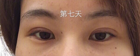 武汉天佑医院整形美容科做双眼皮怎么样？