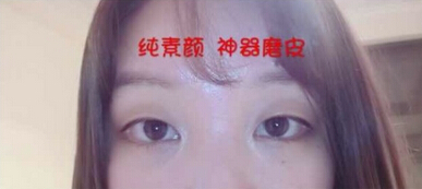 昆明吴氏嘉美做的全切双眼皮手术、去皮去脂