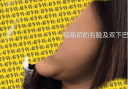 北京陈晓芳医生价格一万一做的*部吸脂