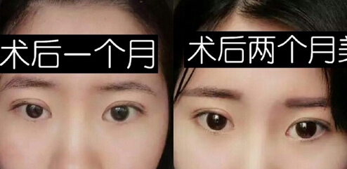 江门华美价格1680做的全切双眼皮