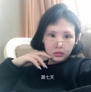 广州壹加壹项美莲主任做的双眼皮开眼角