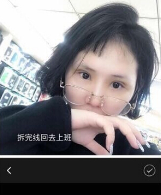 广州壹加壹项美莲主任做的双眼皮开眼角