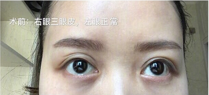 成都华美紫馨艾玉峰双眼皮和眼睑脂肪填充