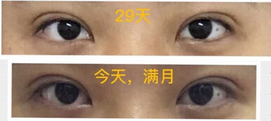 武汉天佑医院李芸做的韩式三点双眼皮手术