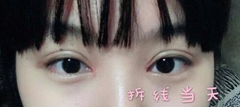 成都美莱梁院长做的双眼皮开眼角去脂手术