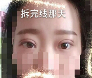 广州军美医院王高峰医生做的全切双眼皮