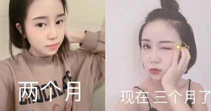 西南医院毕胜医生做的硅胶*手术