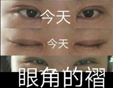 吉林中妍郑莹医生做的双眼皮开眼角手术案例