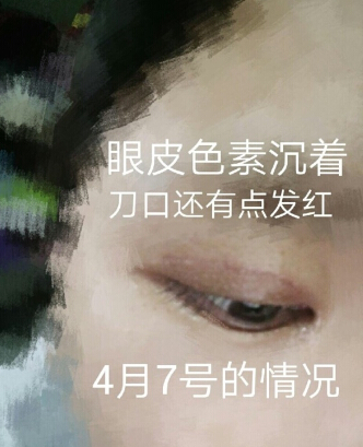 吉林中妍郑莹医生做的双眼皮开眼角手术案例