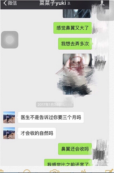 工作室做的耳软骨垫鼻尖，假体隆鼻和鼻翼缩小