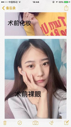 郑州阳光创美杨小顺医生做的双眼皮修复案例