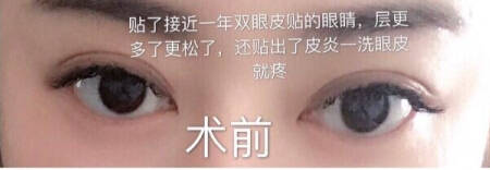 丹熙汪立川医生做的双眼皮去皮去脂手术案例