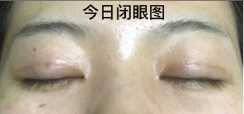 在广州找主任医生做的双眼皮开眼角手术