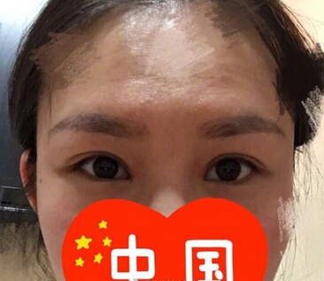 宜春艾莱芙做的双眼皮修复、内眼角