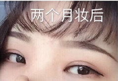 长沙美莱整形医院做的双眼皮开眼角c区增强手术