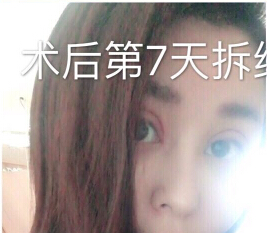 郑州金水周鹏飞医疗美容做的*修复