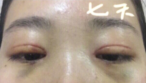 深圳北大医院整形外科李天石做的双眼皮开眼角