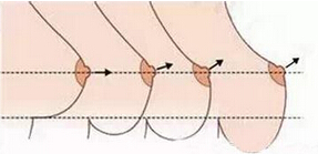 乳房下垂矫正后，还会再垂吗？
