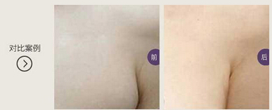 副乳切除手术多少钱？