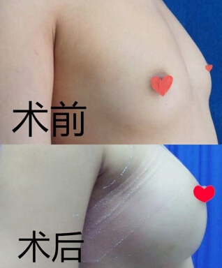 上海九院肖开颜医生做的假体隆胸