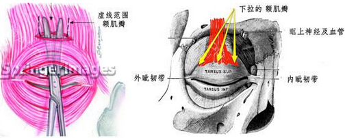 你该了解的上睑下垂