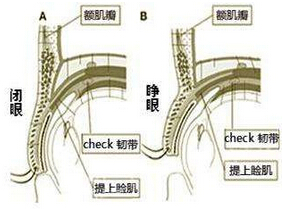 你该了解的上睑下垂
