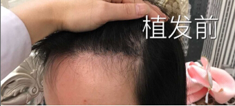 上海kfy做的fue+ptt植发际线