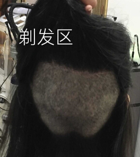 上海kfy做的fue+ptt植发际线