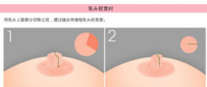 乳头缩小手术多少钱？